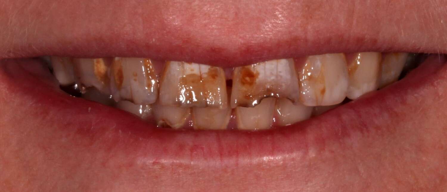 Smile showing lips and teeth. Teeth are dark and stained